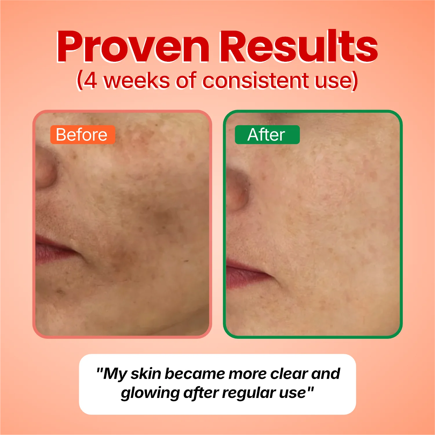 Before and after: brown marks on a customer’s cheek and around her mouth, visibly lighter after 4 weeks of Fade Theory. Her words: My skin became more clear and glowing after regular use.
