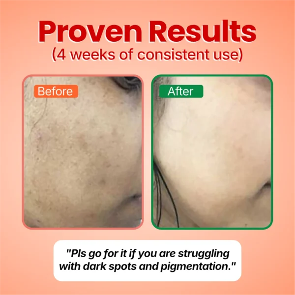 Before and after: a customer’s cheek with dark spots and pigmentation, visibly lighter after 4 weeks of Fade Theory. Her words: Pls go for it if you are struggling with dark spots and pigmentation.
