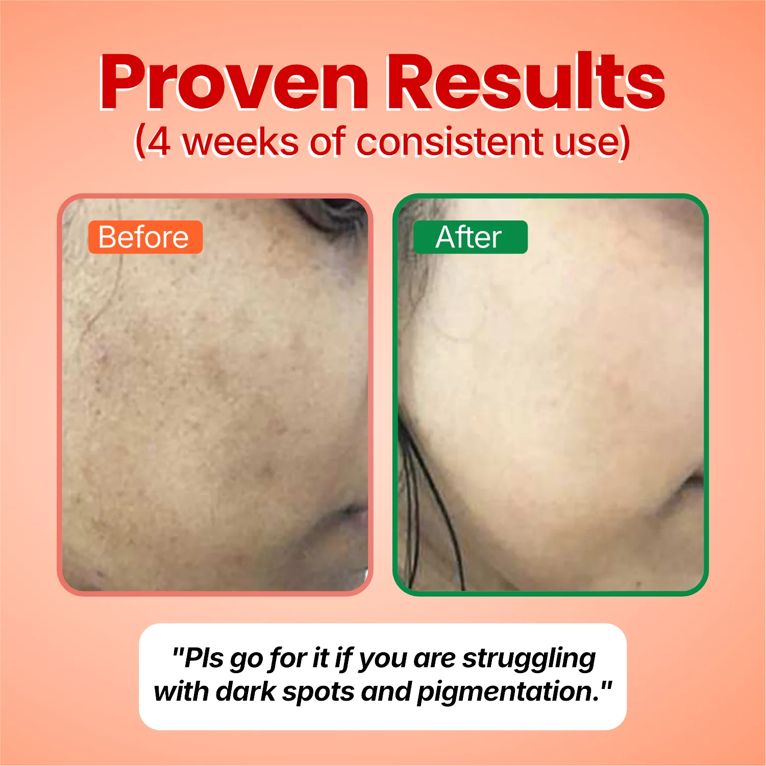 Before and after: a customer’s cheek with dark spots and pigmentation, visibly lighter after 4 weeks of Fade Theory. Her words: Pls go for it if you are struggling with dark spots and pigmentation.